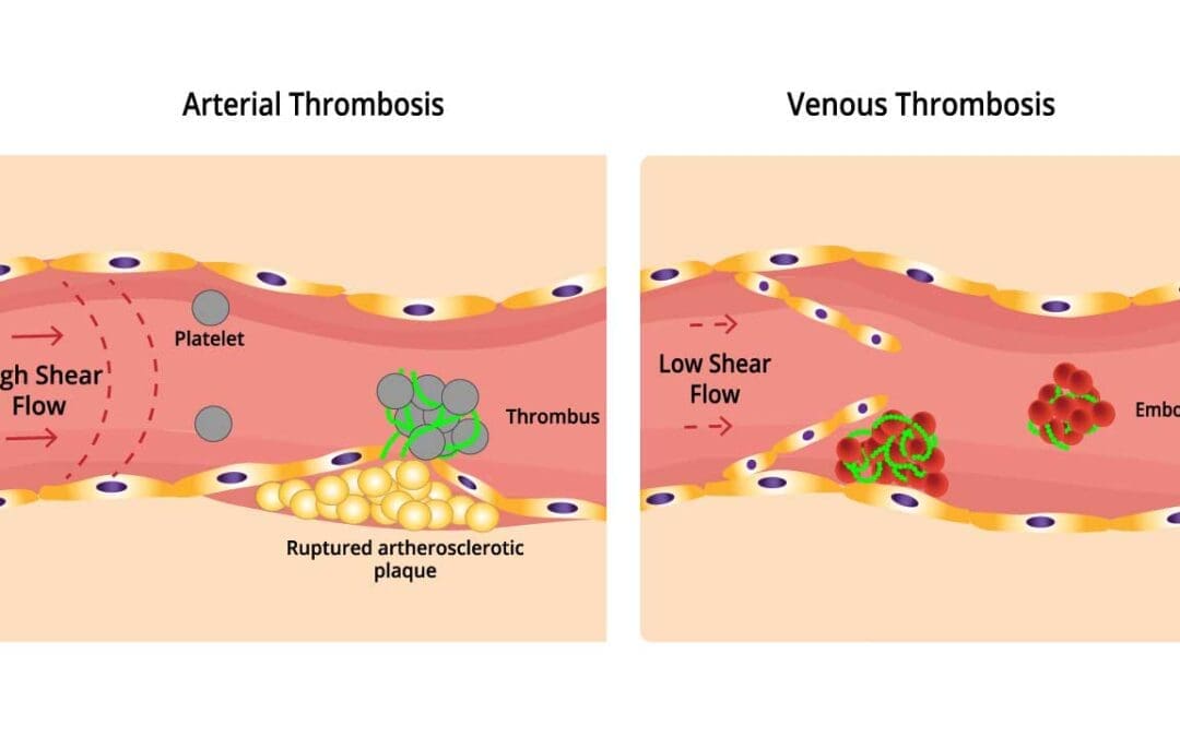 Thrombosis: An Overview