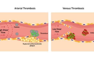 Thrombosis: An Overview