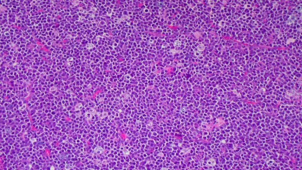 Histological section of lymph node showing lymphoblasts and starry sky appearance in Burkitt lymphoma