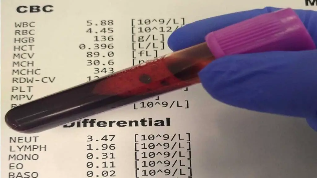 EDTA blood collection for CBC with differential