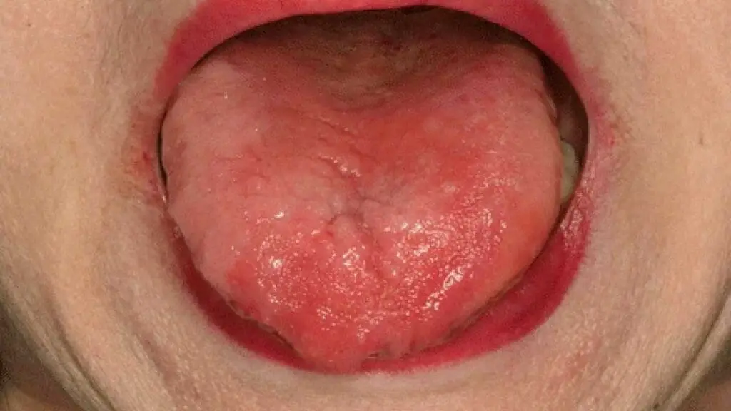 Glossitis can be a characteristic pernicious anemia symptom.