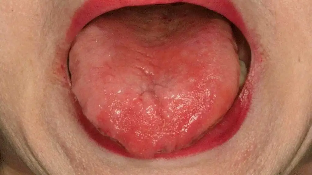 Glossitis can be a characteristic vitamin B12 deficiency symptom.