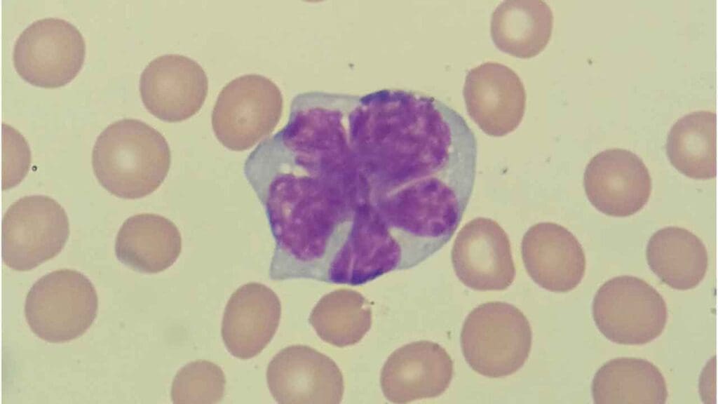 Peripheral blood film of mantle cell lymphoma