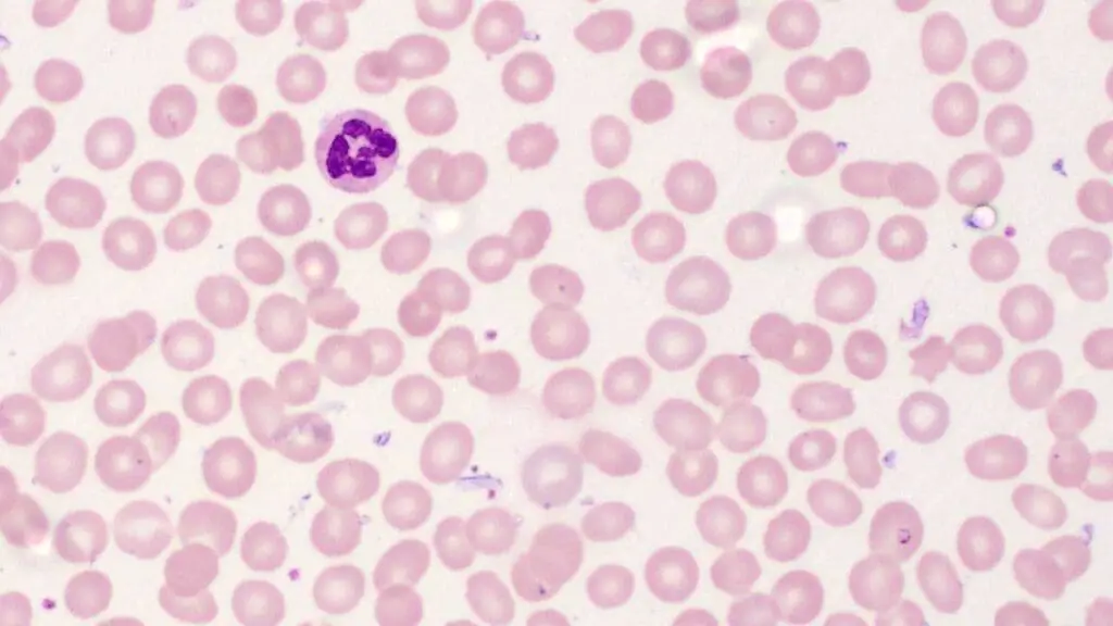 Macrocytosis is seen in the peripheral blood smear of pernicious anemia similar to other causes of vitamin B12 deficiency.