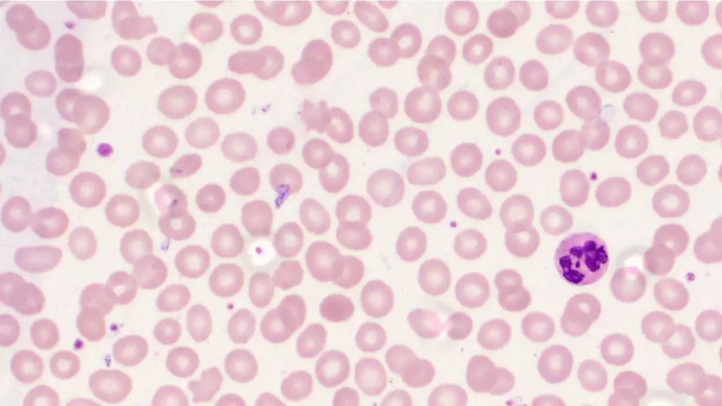A peripheral blood smear in vitamin B12 deficiency reveals the presence of macrocytes, which are abnormally large red blood cells, with poikilocytosis. A hypersegmented neutrophil can also be seen. 
