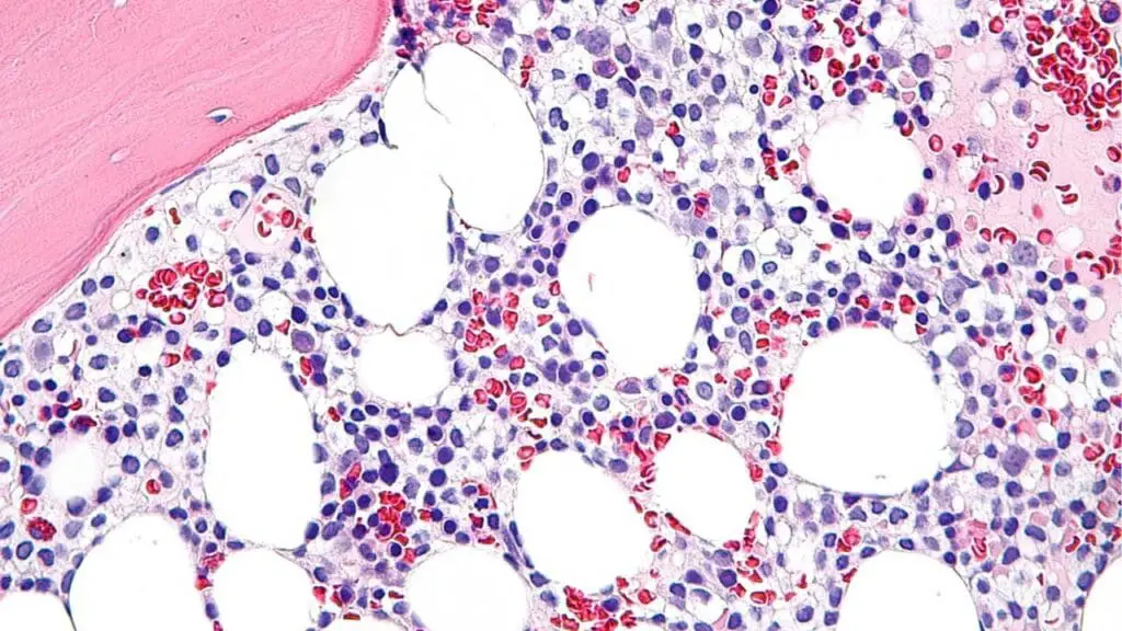 An image of the bone marrow biopsy in Hairy Cell Leukemia : the marrow appears to have a diffuse infiltrate of small lymphoid cells with abundant cytoplasm and ovoid/indented nuclei resembling fried eggs.