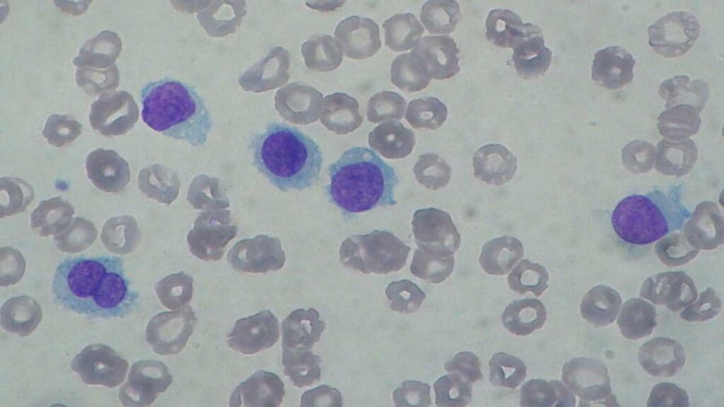 Hairy Cell Leukemia (HCL) peripheral blood smear where the abnormal B cells look "hairy".