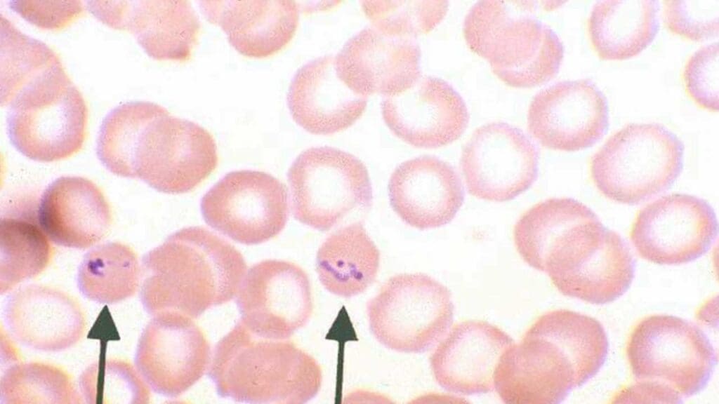 Visualization of malarial parasites in the red blood cells using thick malaria blood smear. 