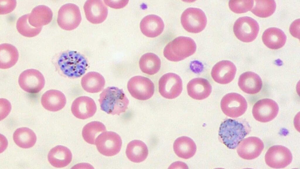 Malarial schizonts seen in a thin peripheral blood smear.  