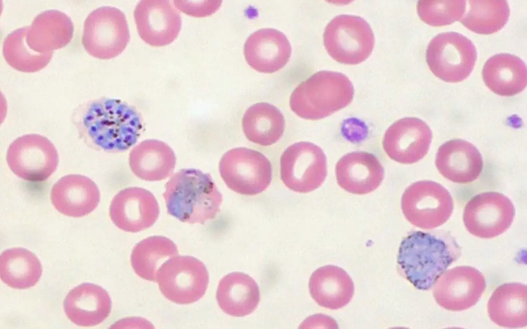 Severe Malarial Anemia