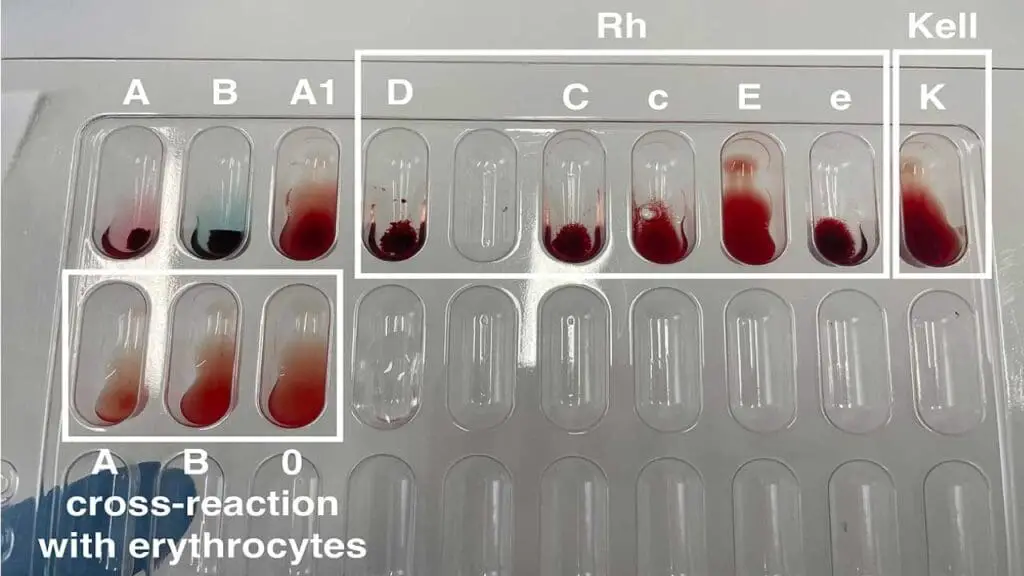 Blood group typing for ABO, Kell and Rh blood group systems. 