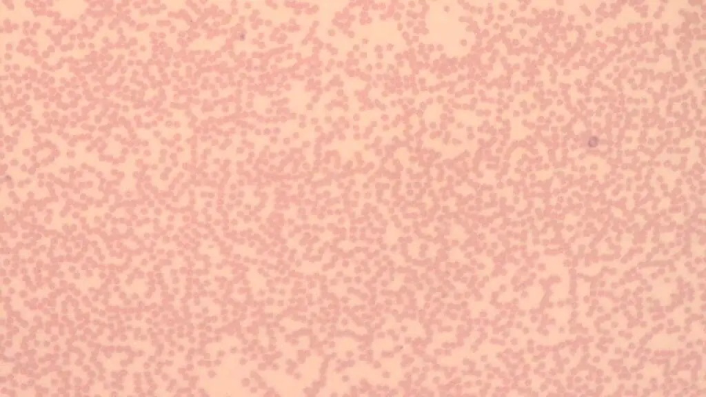 Peripheral blood smear with significant neutropenia under 10x magnification. 