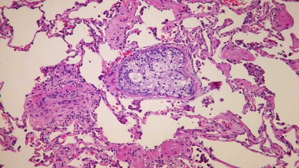 Metastatic prostatic adenocarcinoma occluding the lumen of a pulmonary arteriole as tumor embolus