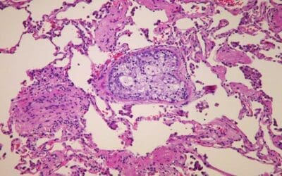 Embolus & Embolism