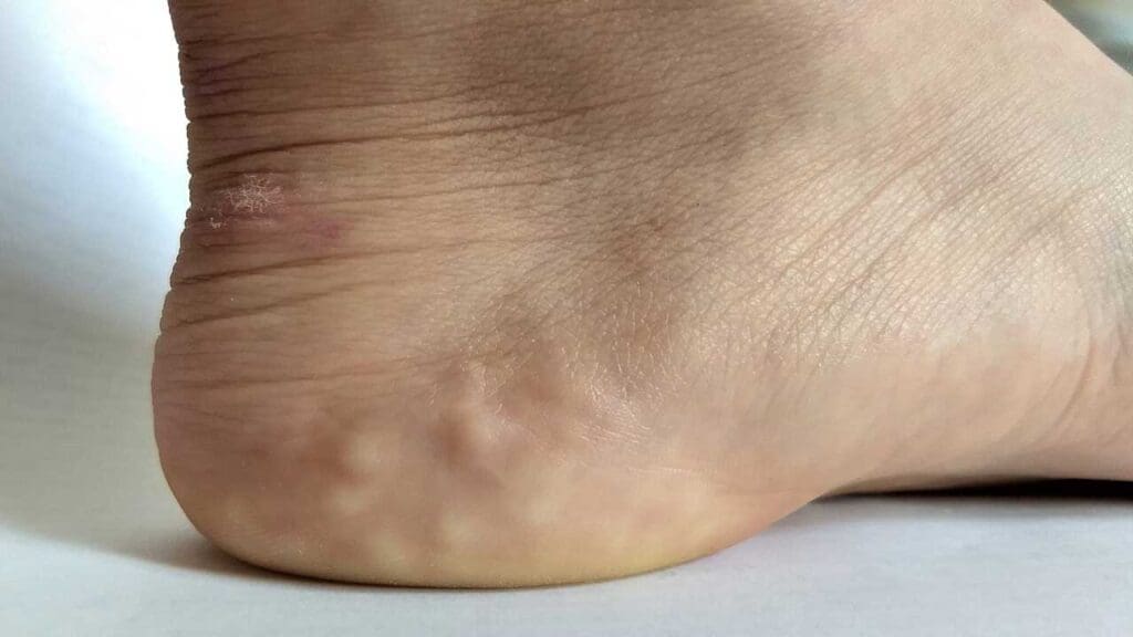 Piezogenic papules, or fat herniations through the fascial layers of the heel.