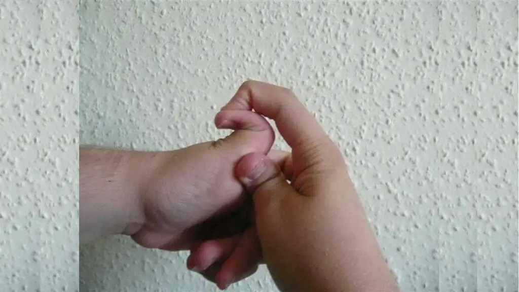 Thumb joint hypermobility in a 16 year old male with EDS. 