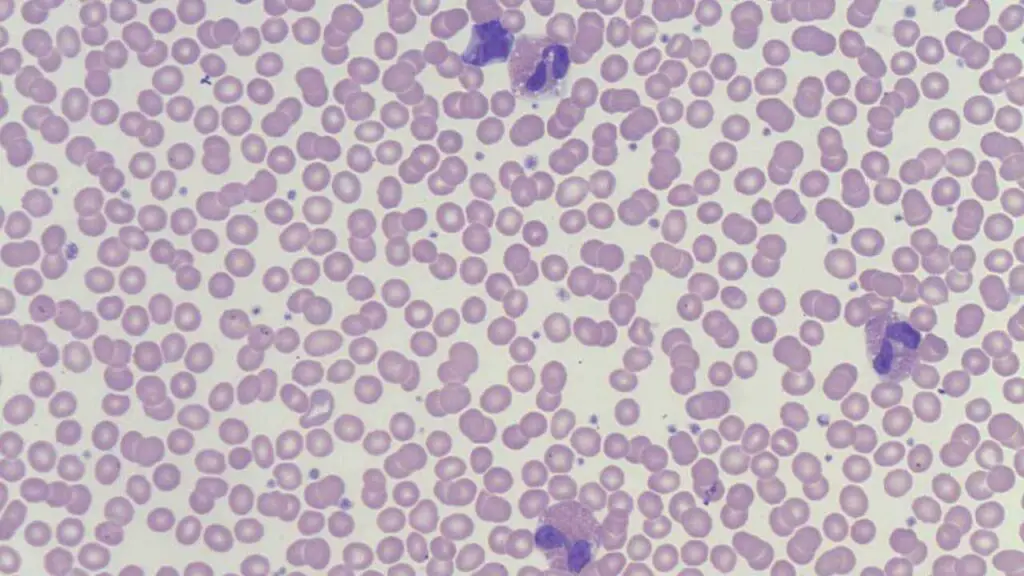 A blood film from a patient with allergic reaction showing eosinophilia