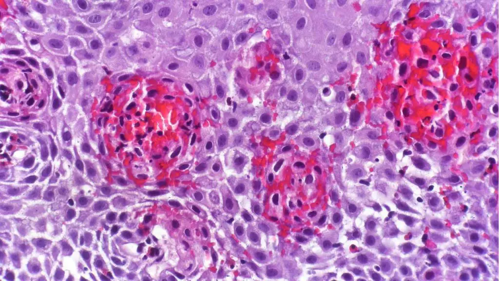 Eosinophilic esophagitis with prominent intraepithelial eosinophils, eosinophilic microabscesses, basal cell hyperplasia, elongation of the vascular papillae and marked intercellular edema. H&E Stain.