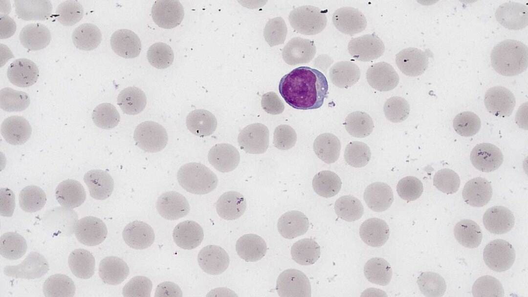 Absolute Lymphocte Normal Lymphocytes: Definition, Function & Causes of High and Low Count