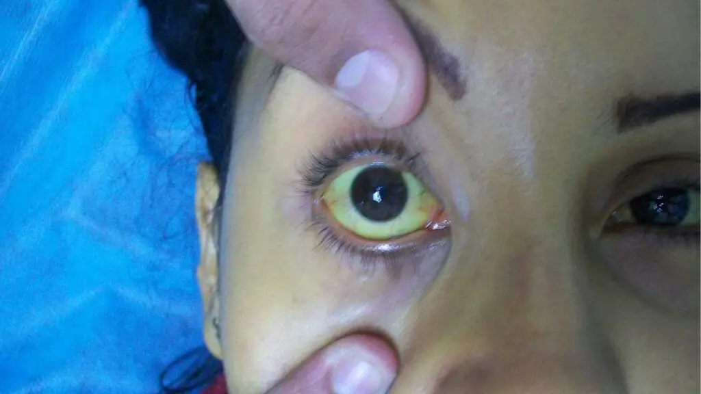 A female patient with ascending cholangitis presenting with sclerotic jaundice