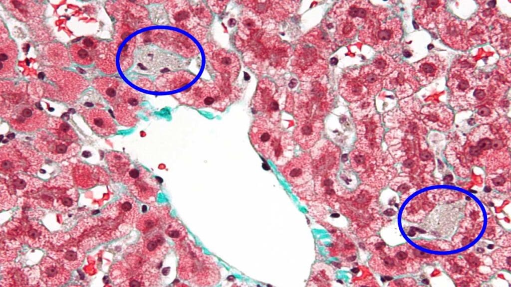 A close-up image of Kupffer cells in a healing congested liver. The sample was taken from a liver biopsy and stained with trichrome.