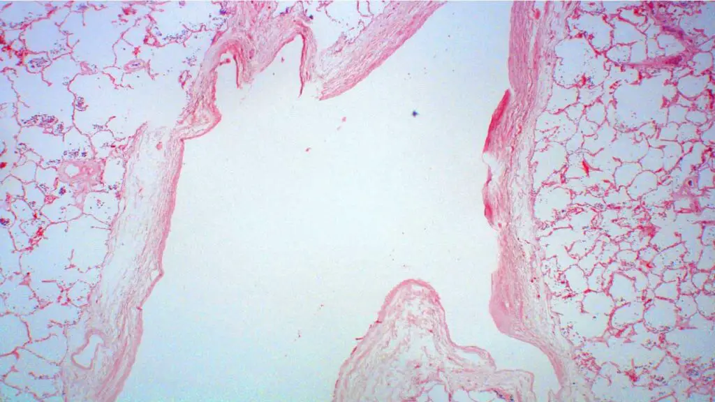 Arteriovenous malformation in hereditary hemorrhagic telangiectasia