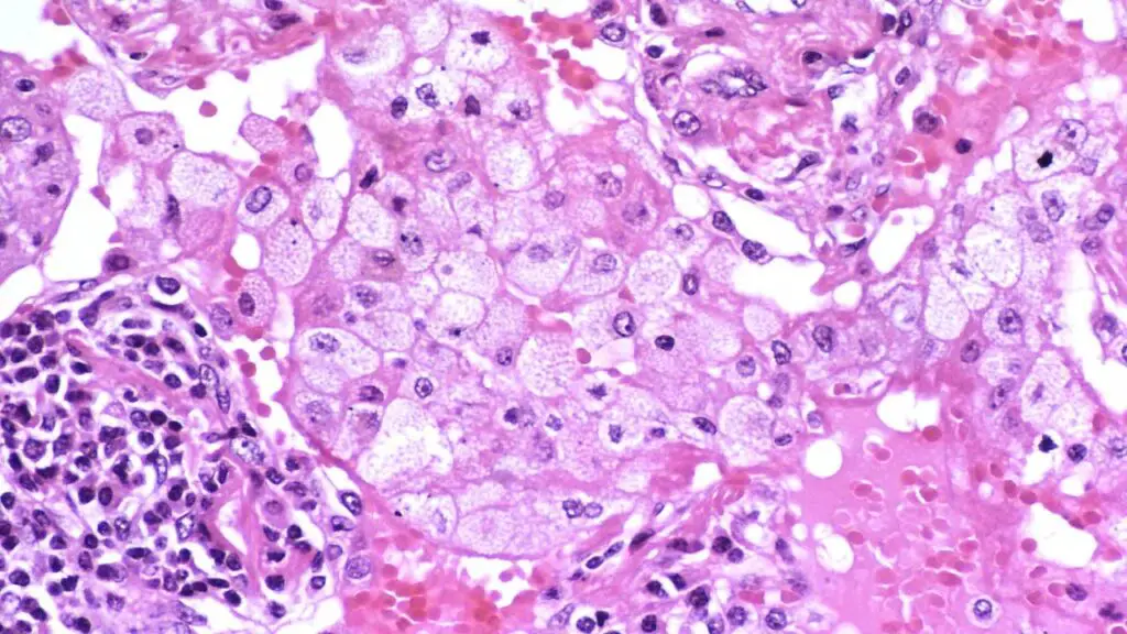 In organizing pneumonia, blocked airways lead to the buildup of surfactant in the lungs. This surfactant is then broken down by macrophages, creating the foamy appearance of intraalveolar macrophages often seen in this condition. This buildup and breakdown process is characteristic of obstructive pneumonia.