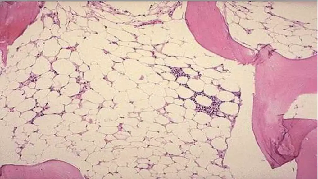 Hypocellular bone marrow in Fanconi anemia