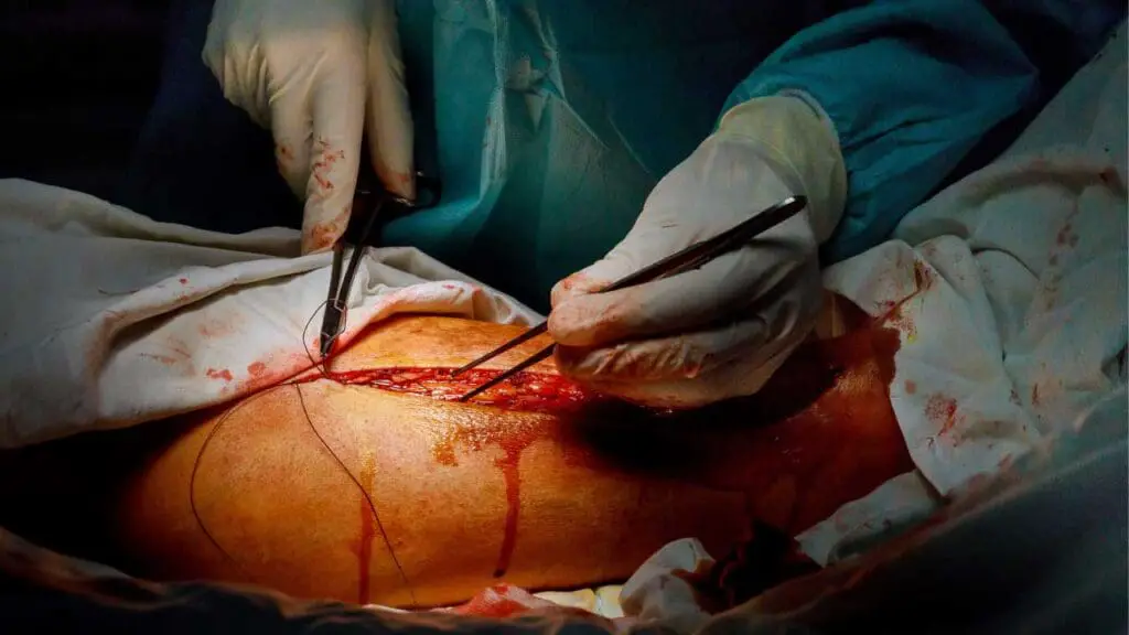 Surgery can trigger catastrophic antiphospholipid syndrome as a precipitating factor.