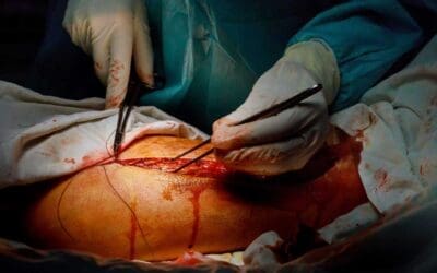 Catastrophic Antiphospholipid Syndrome