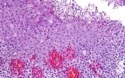 Eosinophilic Esophagitis (EoE)
