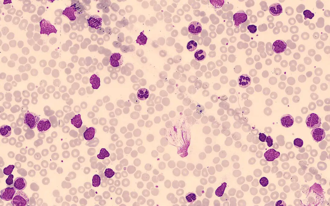 Neutrophilia (High Neutrophils) & Absolute Neutrophilia