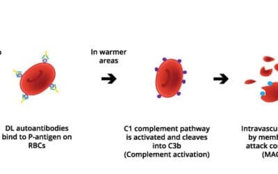 Paroxysmal Cold Hemoglobinuria