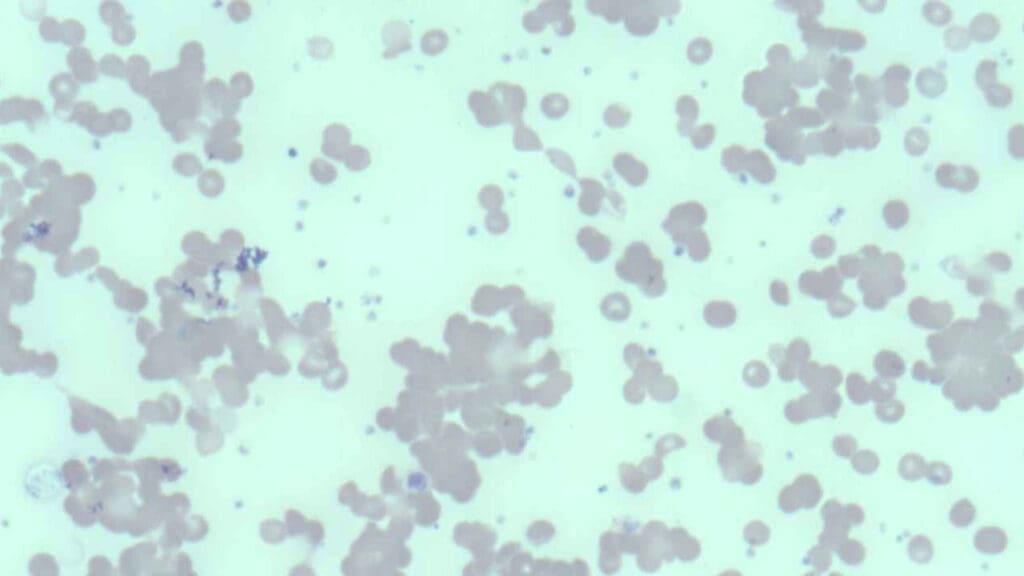 Red cell agglutination seen in cold agglutinin disease.