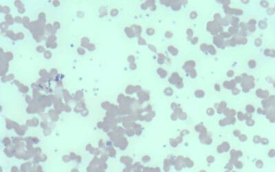 Cold Agglutinin Disease