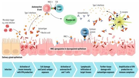 Sjogren Reticular Pattern Sjögren's Syndrome: Symptoms, Causes, Diagnosis & Treatment