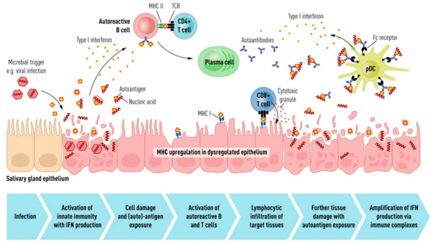 Sjogren Reticular Pattern Sjögren's Syndrome: Symptoms, Causes, Diagnosis & Treatment