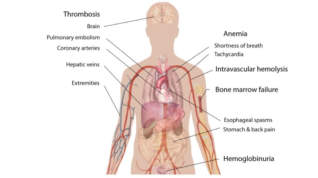 An illustration of the main signs and symptoms of Paroxysmal Nocturnal Hemoglobinuria (PNH).