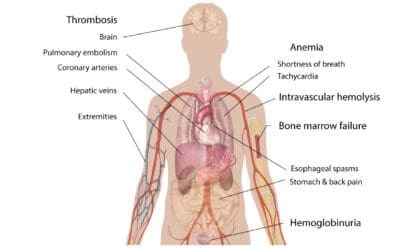Paroxysmal Nocturnal Hemoglobinuria (PNH)
