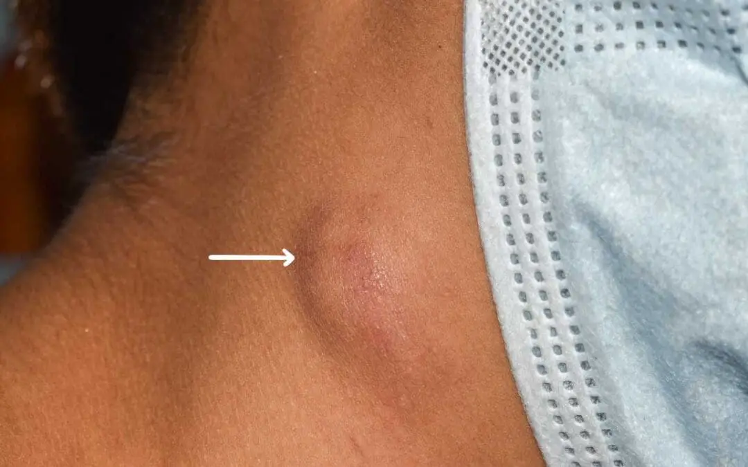 Lymphadenopathy