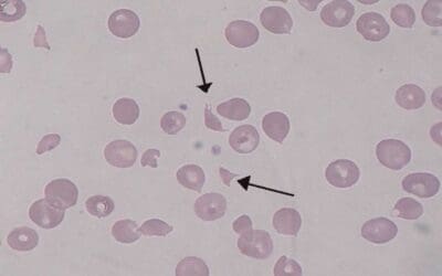 Hemolytic Uremic Syndrome (HUS)