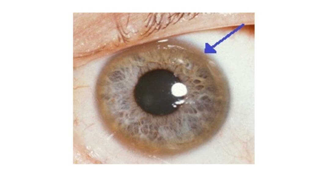 Kayser-Fleischer rings are almost always diagnostic of Wilson's disease
