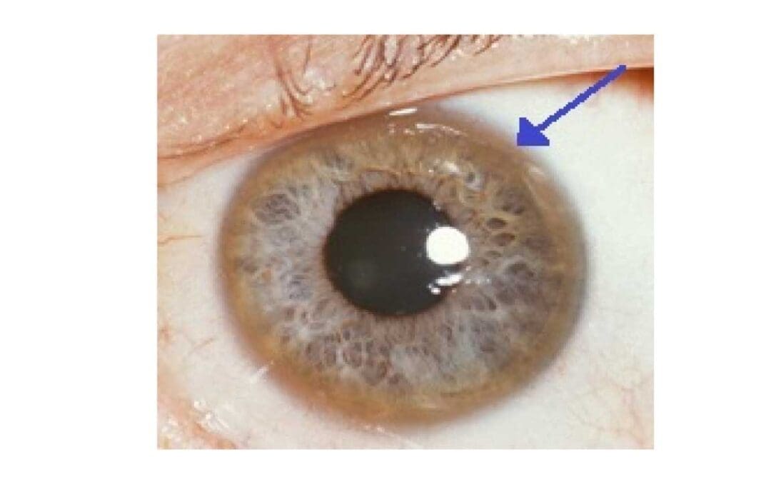 Wilson’s Disease