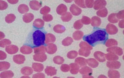 Lymphocytosis (High Lymphocytes)