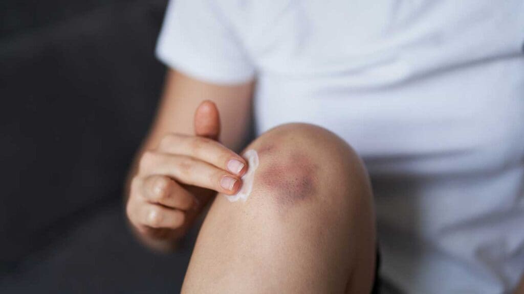 The primary sign of ecchymoses is the visible discoloration of the skin.