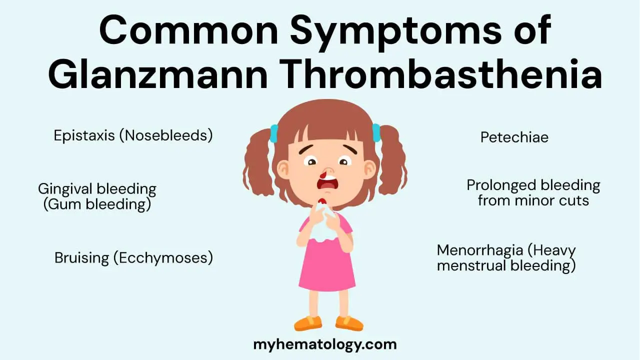 Common symptoms of Glanzmann thrombasthenia include epistaxis, gingival bleeding, bruising, petechiae, prolonged bleeding and menorrhagia.