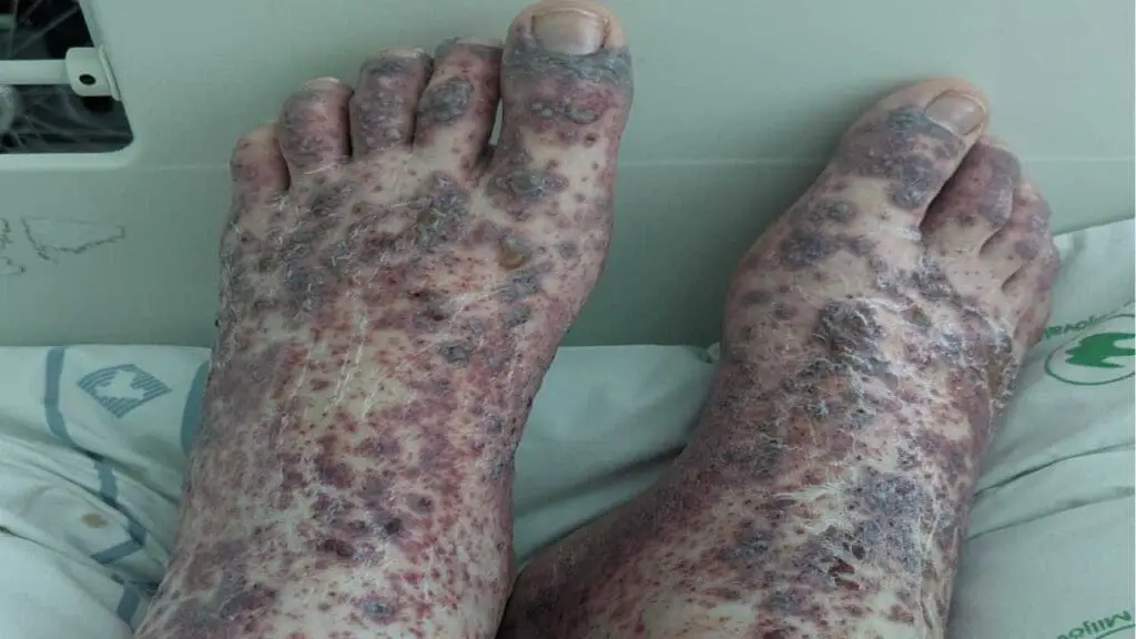 A severe case of Henoch-Schönlein Purpura (HSP) on the feet.