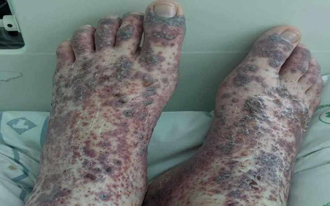 Henoch-Schönlein Purpura (HSP)