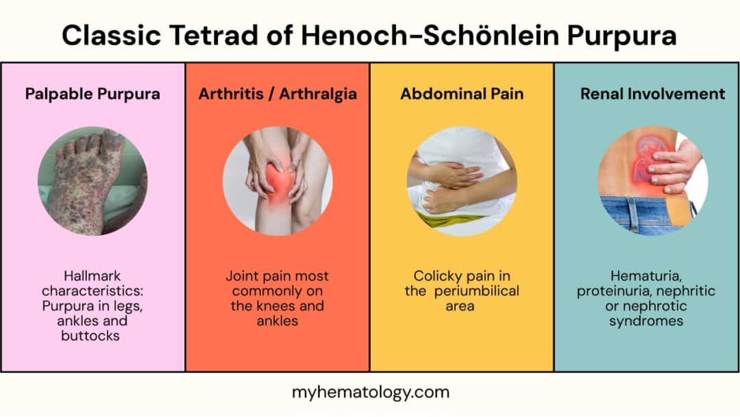 Henoch-Schönlein Purpura (HSP): Causes, Symptoms & Treatment