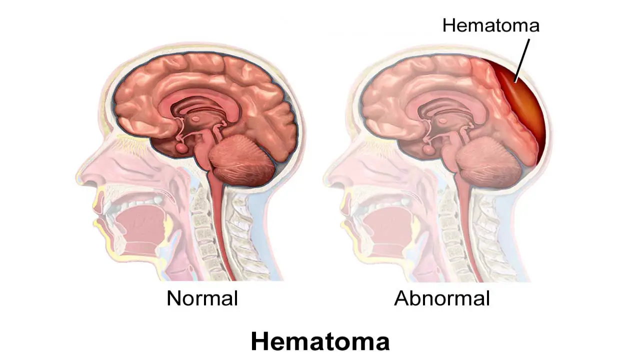 An illustration of hematoma in the brain.